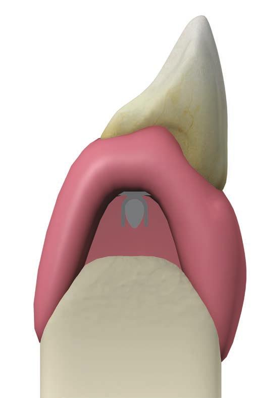 riabilitazione implanto-protesica, pertanto è opportuno verificare con la massima attenzione che il fit tra la barra e le piattaforme implantari sia adeguato.