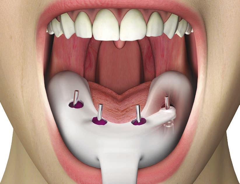 PROTOCOLLI DI UTILIZZO Barra su P.A.D.: impronta con transfer P.A.D. Pick-up Inserire gli abutment P.A.D. nelle connessioni implantari e avvitare i transfer Pick-up PAD-TRA rotanti.