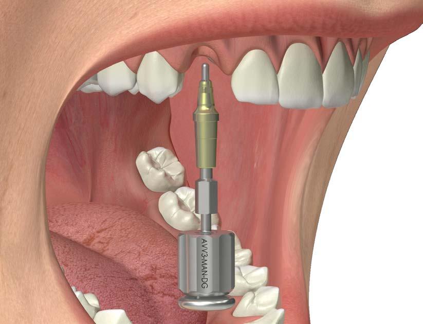 Rimuovere l insieme del dispositivo di estrazione dalla bocca del paziente a cui resterà unito anche il