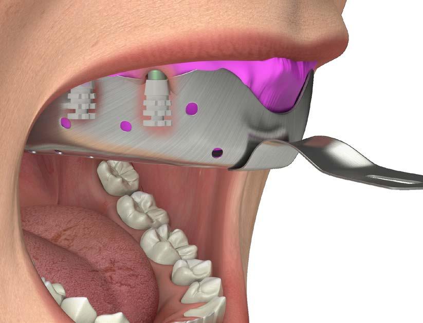 IMPRONTA A CUCCHIAIO CHIUSO Scegliere un cucchiaio di dimensioni adeguate, in modo che l