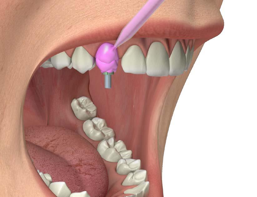 PROTOCOLLI DI UTILIZZO Impronta con transfer Pick-up corona singola Esporre la connessione implantare, qualora sia stato adottato un protocollo in doppia fase chirurgica, oppure rimuovere la vite