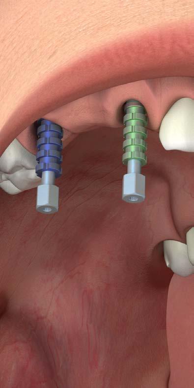 PROTOCOLLI DI UTILIZZO Impronta con transfer Pick-up - multipla Esporre le connessioni implantari, qualora sia stato adottato un protocollo in doppia fase chirurgica, oppure rimuovere le viti