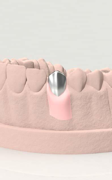sul modello per riprodurre fedelmente la morfologia del pilastro VSR-MDAD avvitato in bocca al paziente.