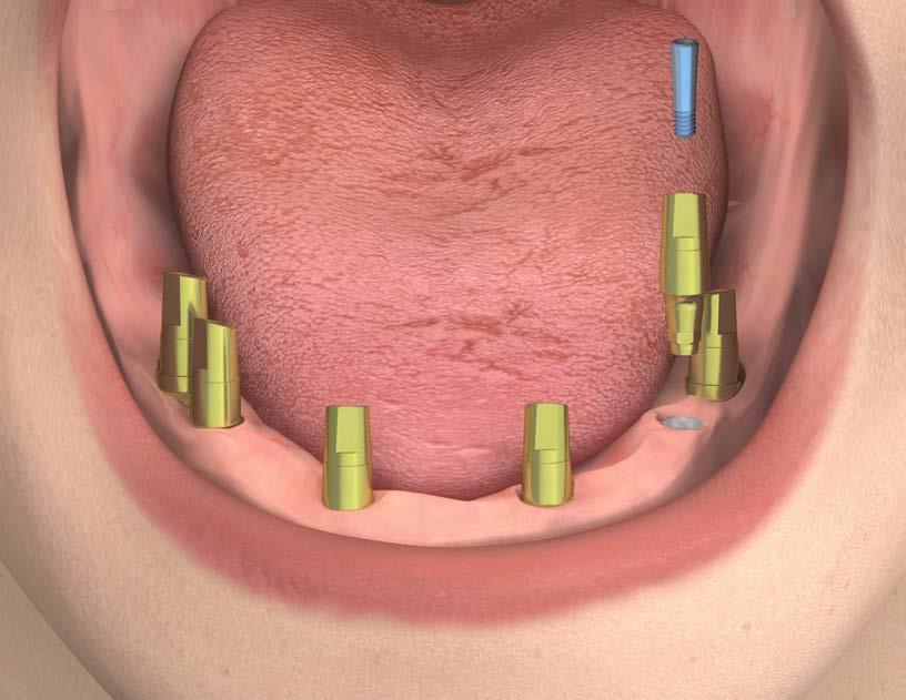 RIABILITAZIONE DEFINITIVA CON PILASTRI PREFORMATI Avvitare i pilastri