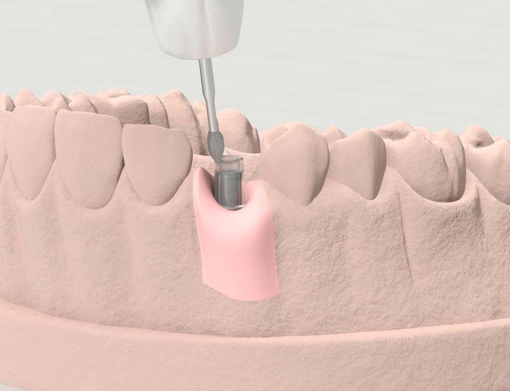 PROTOCOLLI DI UTILIZZO Riabilitazione definitiva singola avvitata su pilastro calcinabile con base in lega Sul modello di precisione inserire un pilastro calcinabile con base in metallo.