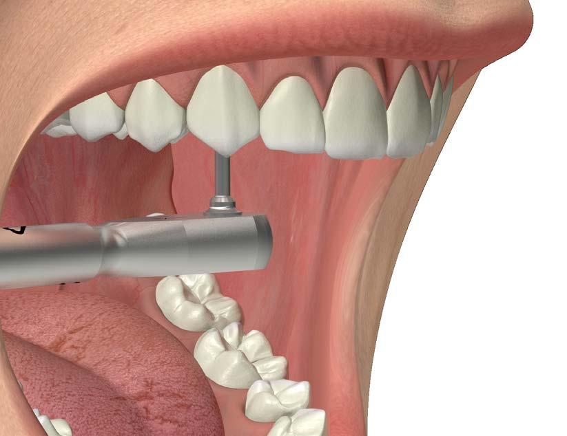 RIABILITAZIONE DEFINITIVA CON PILASTRICALCINABILI CON BASE IN METALLO Procedere alla sovrafusione come d abitudine. Si vedano i suggerimenti a pag.