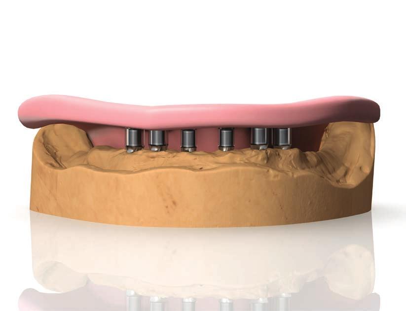 PROTOCOLLI DI UTILIZZO Riabilitazione definitiva per Full Arch avvitata su pilastri con base in lega Rimuovere il provvisorio dalla bocca del paziente e prendere una impronta di precisione (pag.