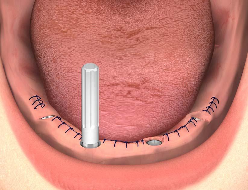 quanto quello degli abutment angolati. Le medesime procedure di inserimento sono valide anche qualora la riabilitazione preveda un numero superiore di impianti.