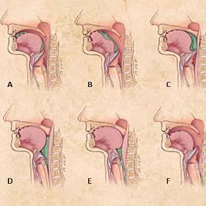 Deglutizione Corretto transito del bolo nelle vie digestive superiori.