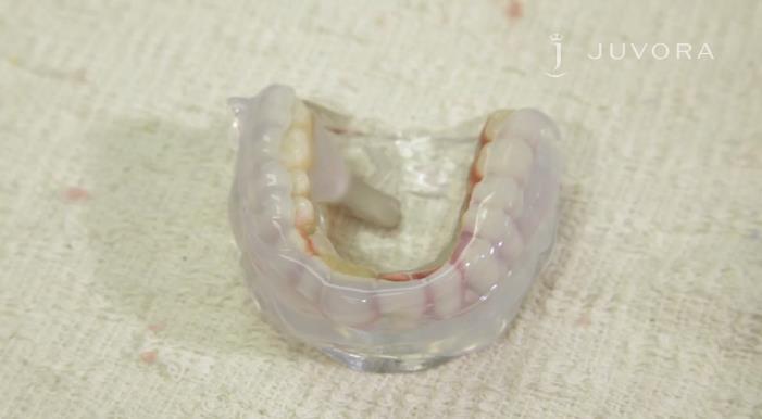 Posizionamento dei denti 1)Per il posizionamento dei denti artificiali si utilizza cera rosa o cera da montaggio.