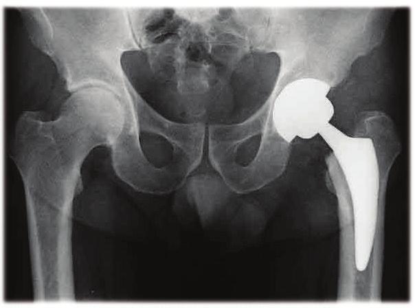 Introduzione La protesizzazione dell articolazione dell anca può essere dovuta a: Fratture. Malformazioni congenite. Degenerazioni artrosiche. Osteoporosi. Ecc.