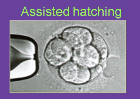 ASSISTED HATCHING SUGLI EMRBIOI TRASFERITI IN UTERO Sugli embrioni provenienti da cicli di fecondazione in vitro è possibile eseguire l assisted hatching.