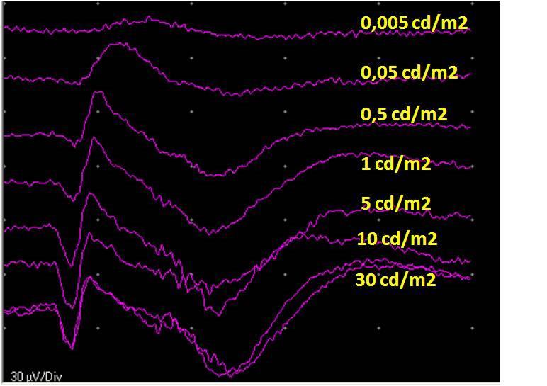 Flicker ERG 20 Hz Flicker ERG 30 Hz Figura 1: risposta Flicker ERG a crescente frequenza di stimolo (5-10-20-30 Hz) Le componenti più importanti dell ERG L ERG è caratterizzato da una deflessione