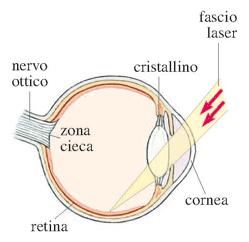 Un fascio laser è focalizzato sulla retina della cornea e dal cristallino in una piccola macchia luminosa dove