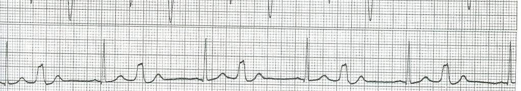 con QRS largo. Talvolta interpolato.