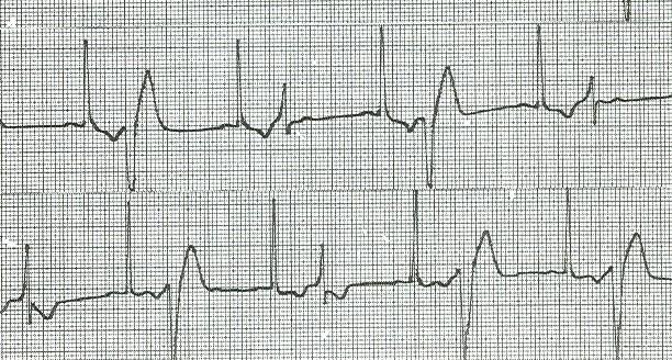 Generalmente in cardiopatici.