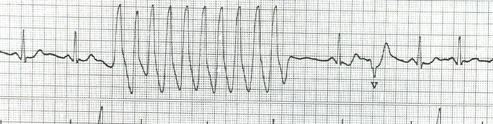 TACHICARDIA VENTRICOLARE NON SOSTENUTA Consiste in 6