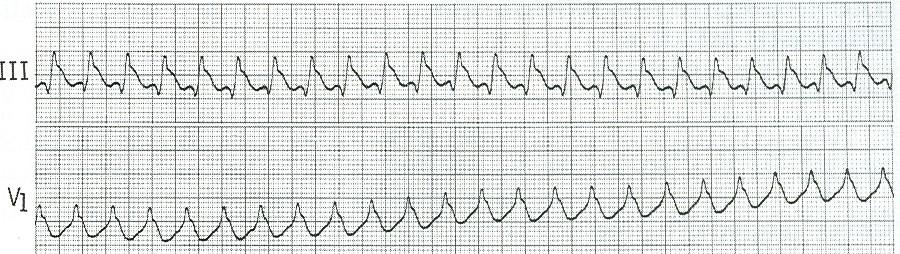 TACHICARDIA VENTRICOLARE
