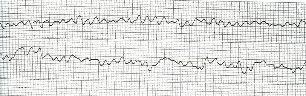 FIBRILLAZIONE VENTRICOLARE E un susseguirsi caotico di complessi polimorfi molto rapidi.