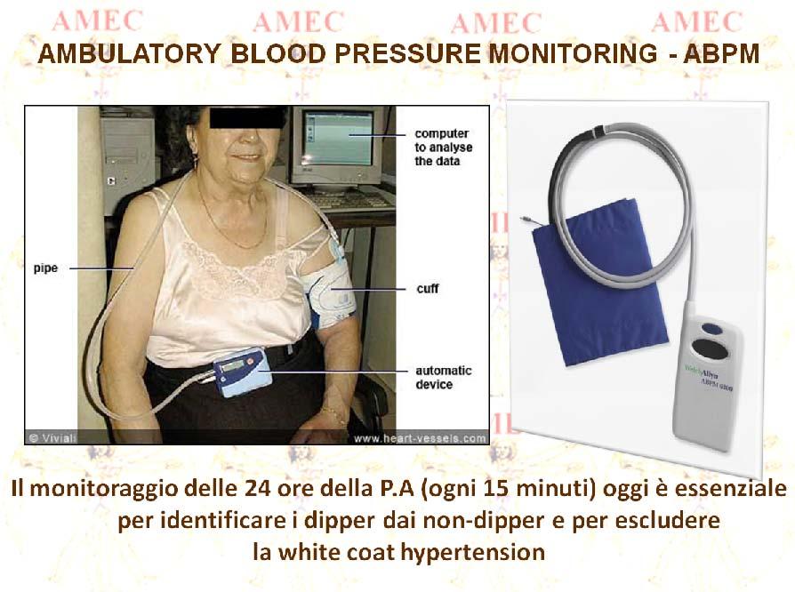 CLASSIFICAZIONE DELL IPERTENSIONE Ipertensione sistolica isolata: PA sistolica > 140 mm Hg e PA diastolica < 90 mm Hg.