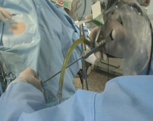 uretero-litotrissia mediante utilizzo di strumentario endoscopico (rigo o flessibile) in grado di procedere sotto visione diretta all interno dell uretere.
