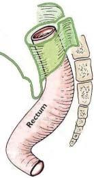 rettali superiori (2) La sezione distale del sigma viene realizzata sotto la congiunzione colon-rettale () L anastomosi viene effettuata tra la