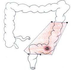 (CHOP) utilizza il rapporto anatomico del retto con il peritoneo per differenziare l'intervento chirurgico del colon da quello del retto in caso di