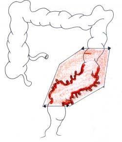 76 = colon (6) Resezione di porzioni extraperitoneali del retto (sotto falda peritoneale) = rettosigmoidectomia (48.