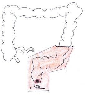 Localizzazione Resezione / anastomosi / enterostomia Codici CHOP 207 C. Tumore del basso retto (0 <6 cm dal margine anale ) Falda peritoneale superiore mediano inferiore C.