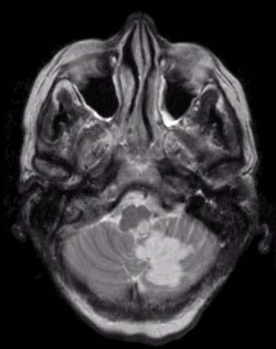 stroke Prognosi a lungo