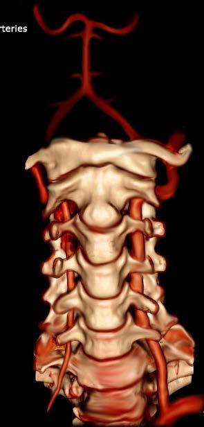 ANATOMIA CIRCOLO POSTERIORE Arteria Cerebrale Posteriore [PCA] Arteria Basilare [BA] Arteria Cerebellare Antero Inferiore