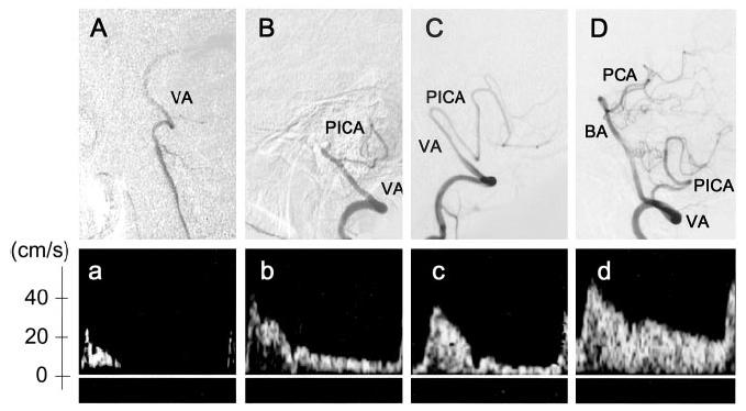 QUADRI PATOLOGICI VERTEBRALI OCCLUSIONE VERTEBRALE EXTRACRANICA Occlusioni prossimali AV: possibile ricanalizzazione distale