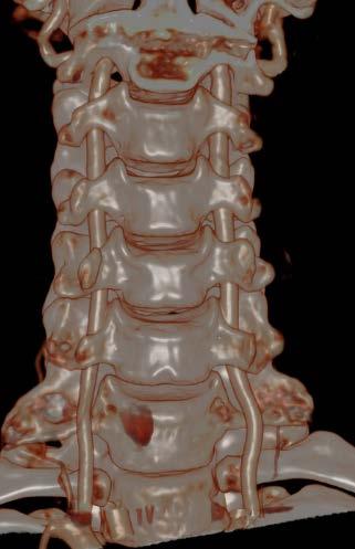 ARTERIA VERTEBRALE Considerazioni generali Ampia variabilità di: lunghezza calibro decorso Asimmetria (65%: sx > dx)