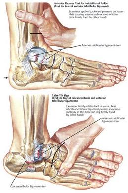 1. legamento peroneo-astragalico anteriore (PAA): nastriforme, origina dal malleolo peroneale e, con decorso orizzontale, si porta anteriormente sull astragalo.