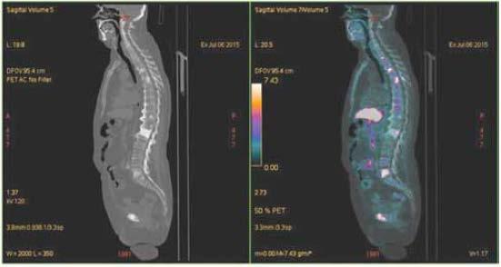 Evaluation of bone metastases by 18F-choline PET/CT in a mcrpc patient treated with radium-223 A B 18F-choline CT (left panel)/pet (right panel) imaging before treatment with radium-223