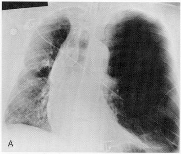 Figura 8a. Bronchiolite obliterante.