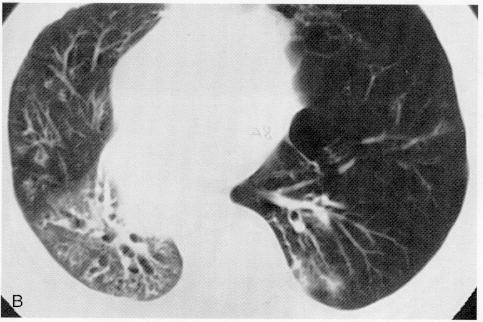 Bronchiectasie e ispessimento delle pareti bronchiali nei lobi inferiori