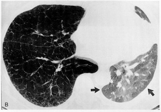 Spesso è possibile evidenziare tramite HRCT un quadro di mosaic pattern che è espressione dell interposizione di regioni di parenchima polmonare normale e regioni di ostruzione che non sono capaci di