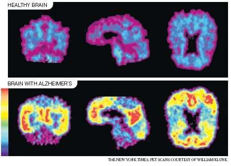 UE: nanoparticelle per diagnosi e cura precoce Alzheimer «BRAINFACTOR.IT http://brainfactor.wordpress.com/2008/09/02/ue-nanoparticelle-per-diagnosi-e-cura-prec.