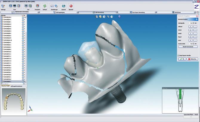 Possibilità d elaborazione digitale per protesi estetiche completamente anatomiche.