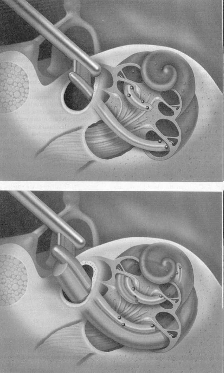 Meningite Complicanza maggiore Preval.