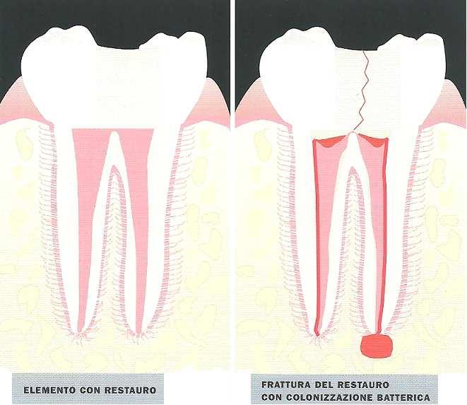 INFILTRAZIONE DA RESTAURO I germi responsabili della carie vivono abitualmente nella nostra bocca e si addensano, grazie a particolari proteine, fino ad aderire tenacemente alle superfici dei denti.