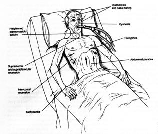 CORSO TEORICO-PRATICO ARIR/AIPO IN RIABILITAZIONE RESPIRATORIA LA RIABILITAZIONE DEL PAZIENTE RESPIRATORIO CRONICAMENTE CRITICO VOLTERRA 8-1 Giugno 26 Centro Congressi della Cassa di Risparmio di