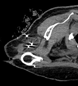 , Critical review and state of the art in interventional oncology: benign and metastatic disease involving bone, Radiology 2012, Filippiadis et al.