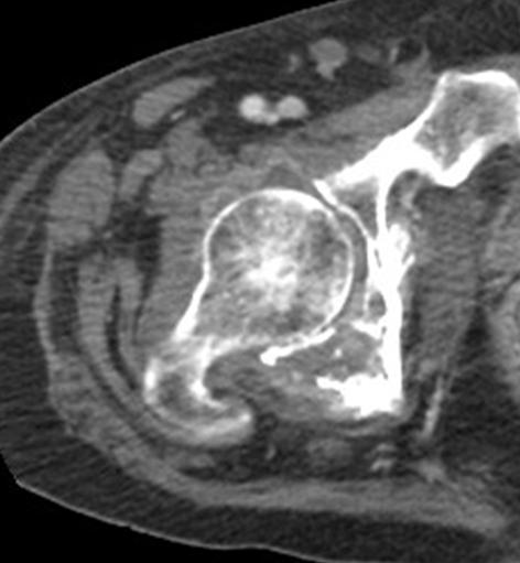 , Microwave thermal ablation of spinal metastatic bone tumors, J Vasc Intervent Radiol 2014: 20 lesioni in 17 pazienti, tempo medio ablazione 4.4 minuti, VAS: 1.3 ± 1.8et (Pal.