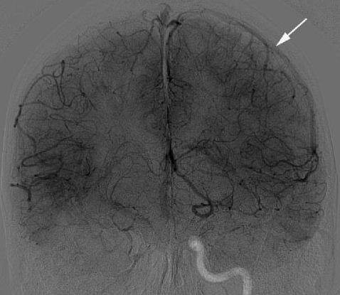 Sacrificio del vaso parente Test di occlusione Venous opacification