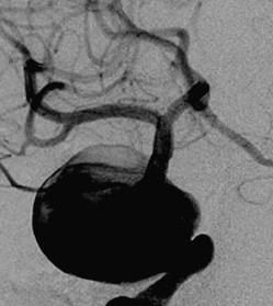 predictor of a subject s ability to tolerate carotid occlusion.