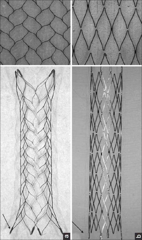 Stent-assisted Coiling Rilasciando lo stent a copertura del colletto prima del rilascio delle spirali se ne previene la