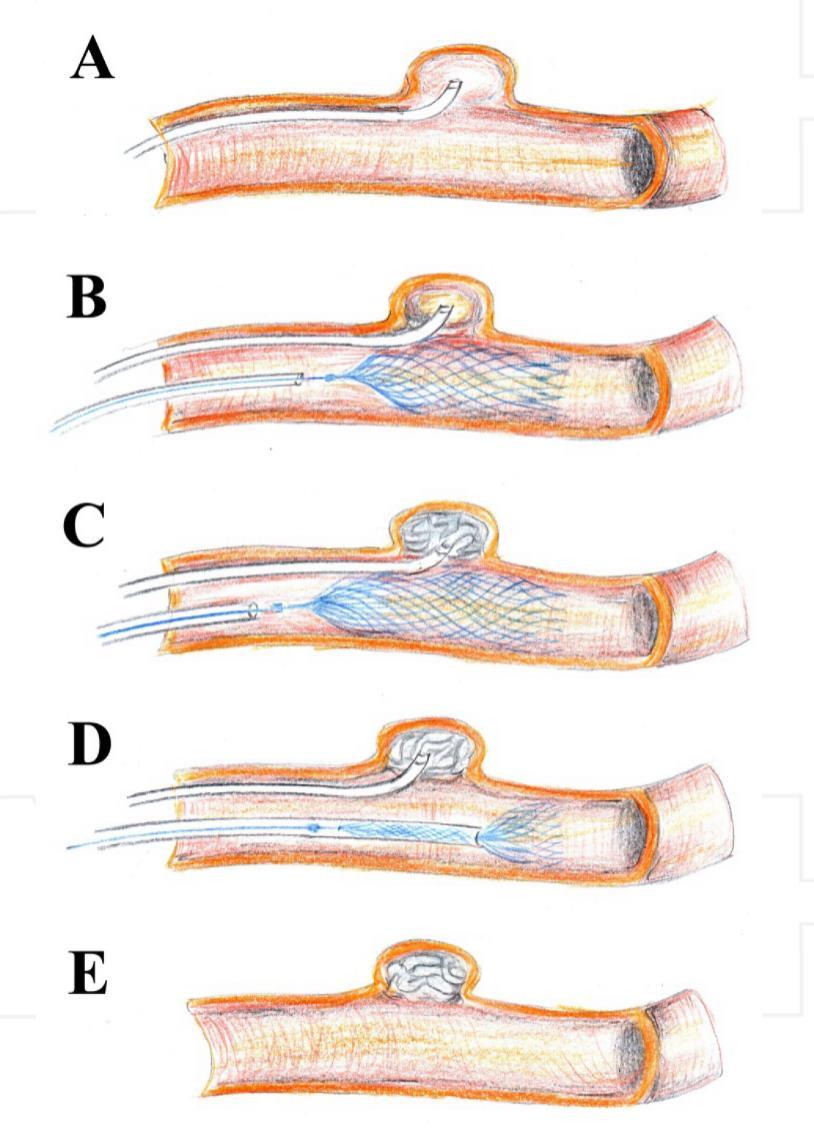 Stent-assisted