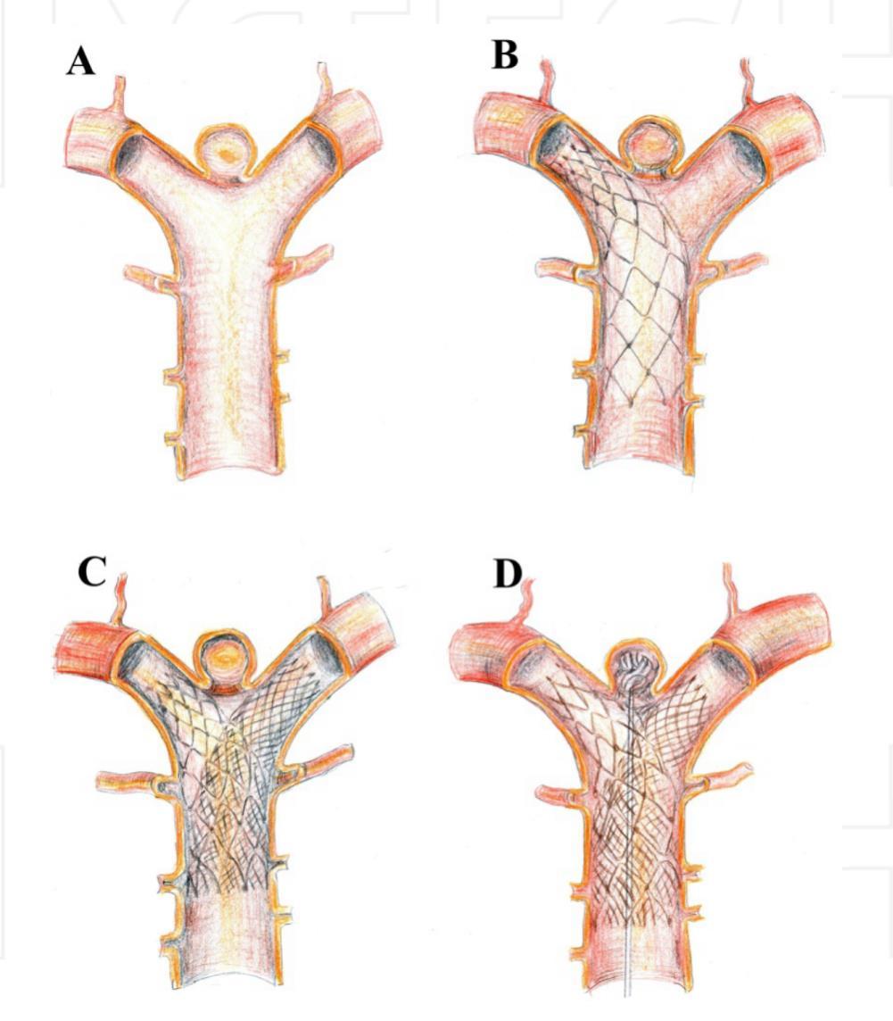 Creative stenting